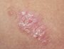 Home Remedies For Healing Psoriasis